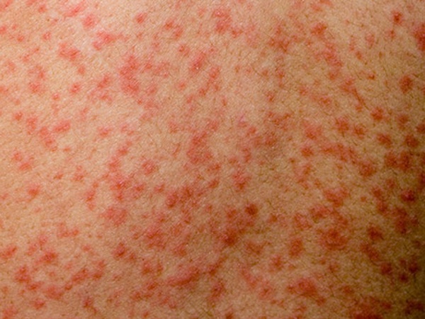 Measles outbreak at 704